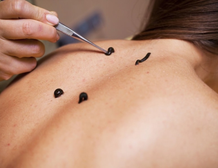 Гирудотерапия - Санаторий «Ченки»